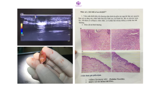 Nodular fasciitis