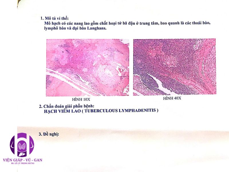 HÌNH 2: Kết quả sinh thiết lõi (CNB) hạch lao vùng cổ nhóm VB bên trái