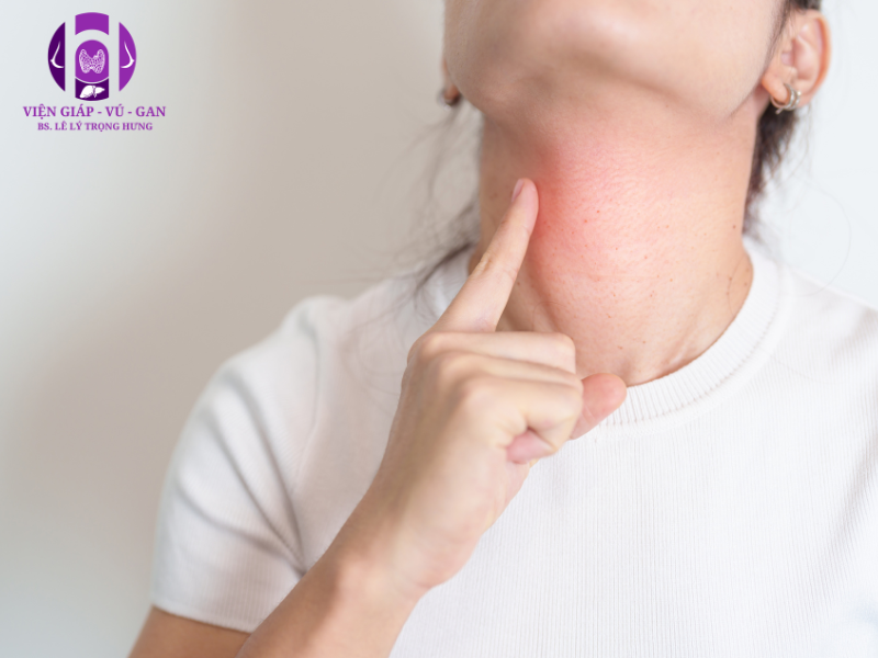 u tuyến giáp gây triệu chứng