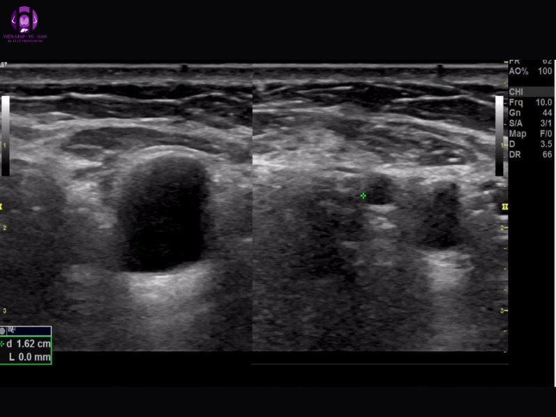 Hình ảnh siêu âm tuyến vú cô N 