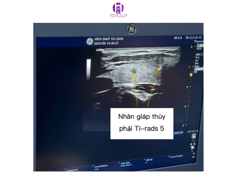 Carcinôm tuyến giáp dạng nhú