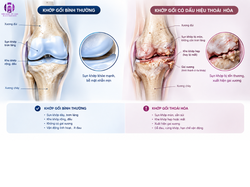dấu hiệu thoái hóa khớp gối