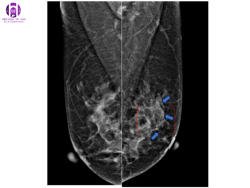 Carcinom tuyến vú xâm nhiễm trên nền DCIS