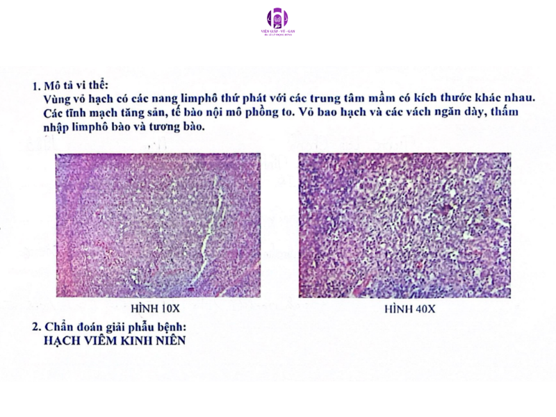 bệnh Castleman