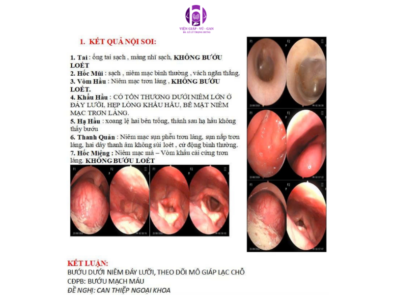tuyến giáp lạc chỗ vùng đáy lưỡi