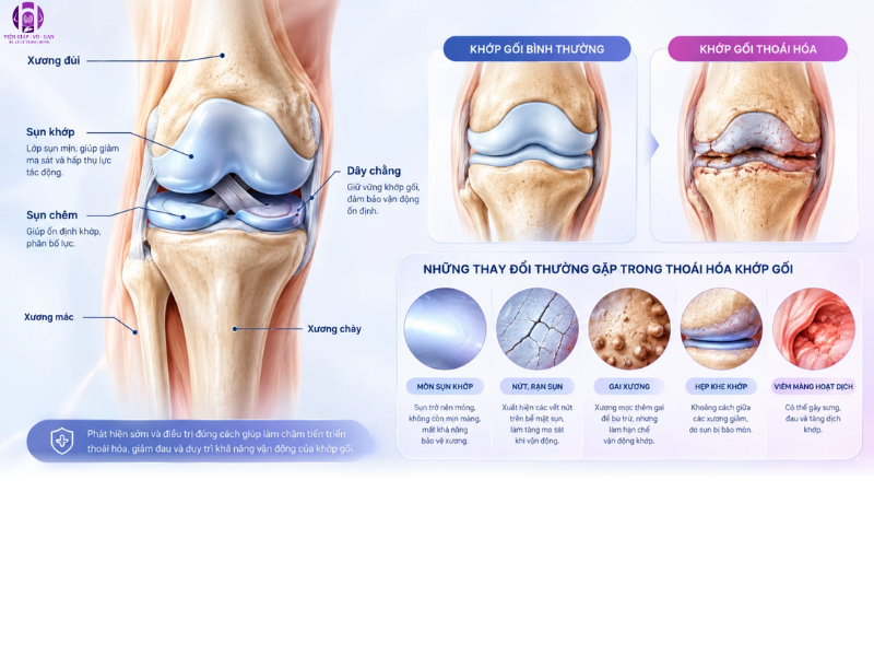 dấu hiệu thoái hóa khớp gối