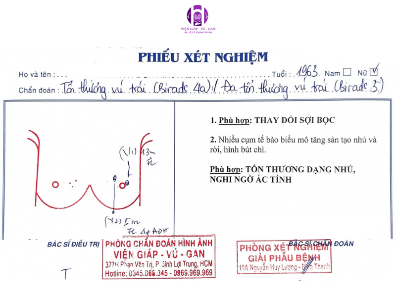 u vú không điển hình lành tính