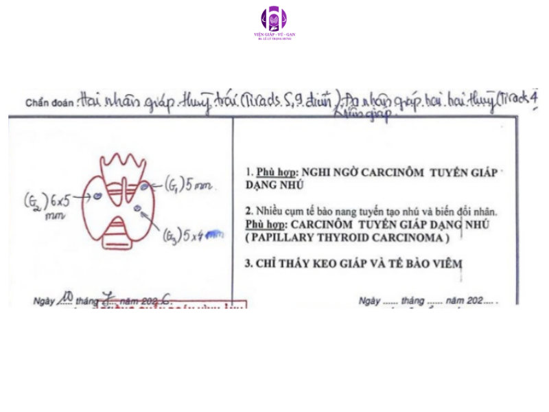 Carcinôm tuyến giáp dạng nhú