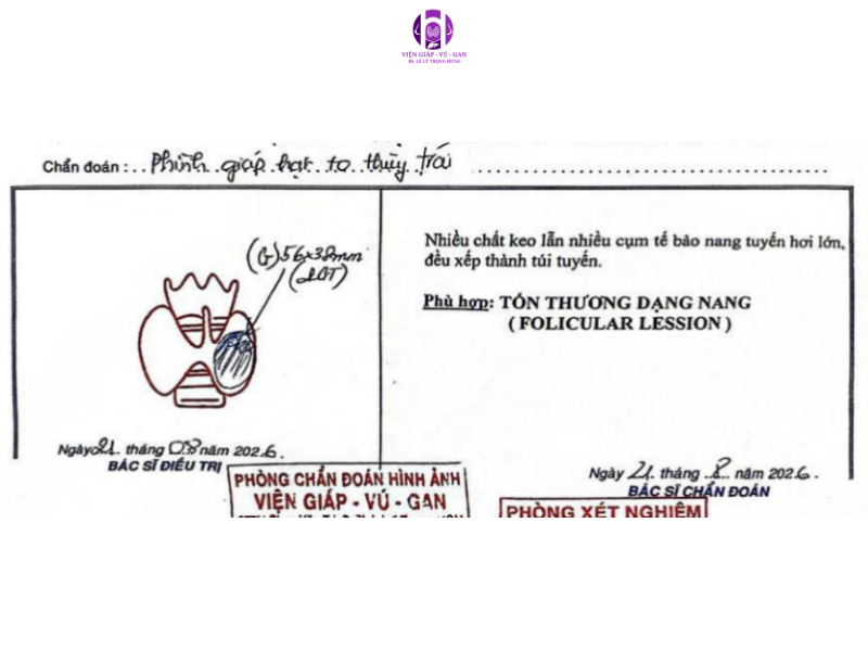 bướu lành tuyến giáp dạng nang