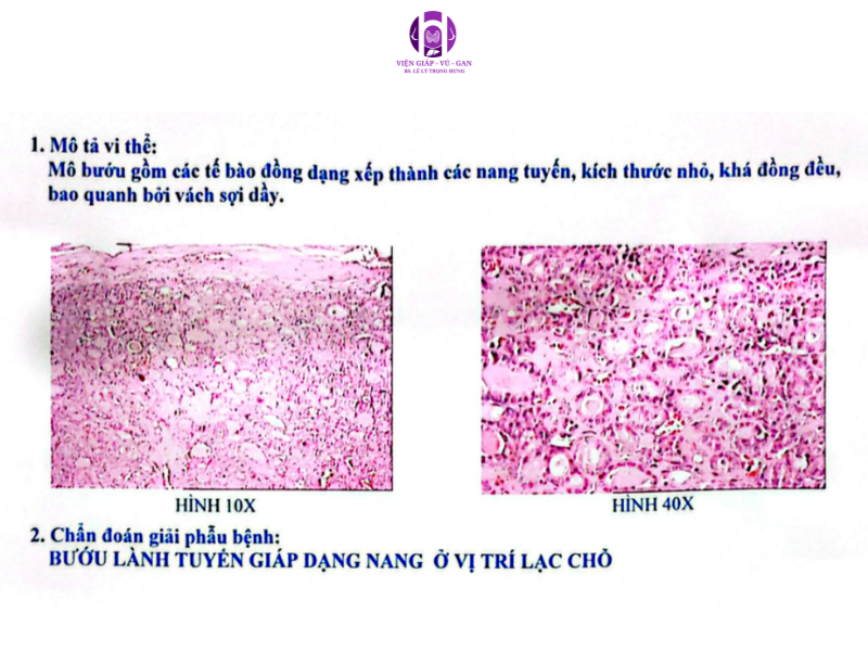 tuyến giáp lạc chỗ vùng đáy lưỡi
