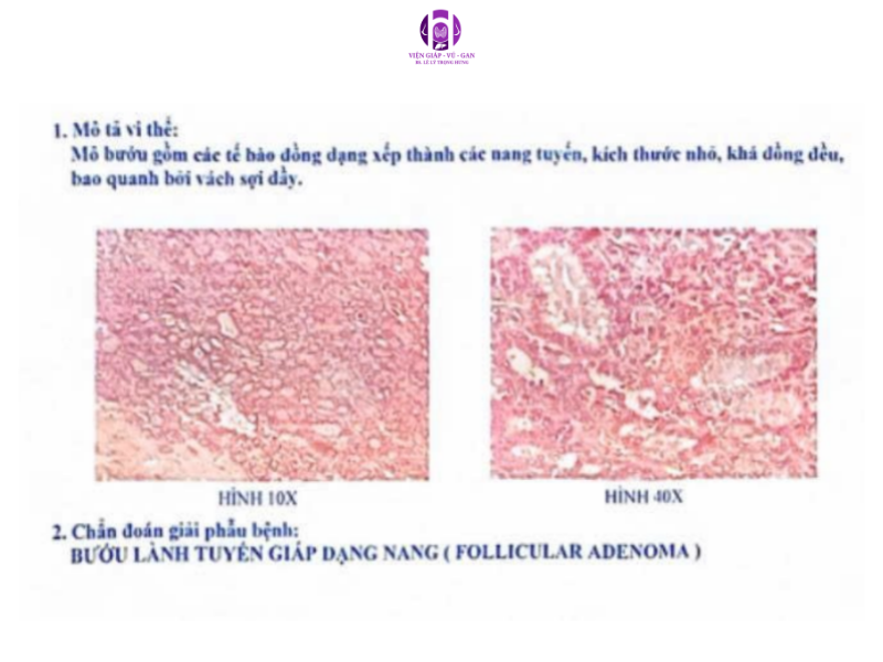 bướu lành tuyến giáp dạng nang