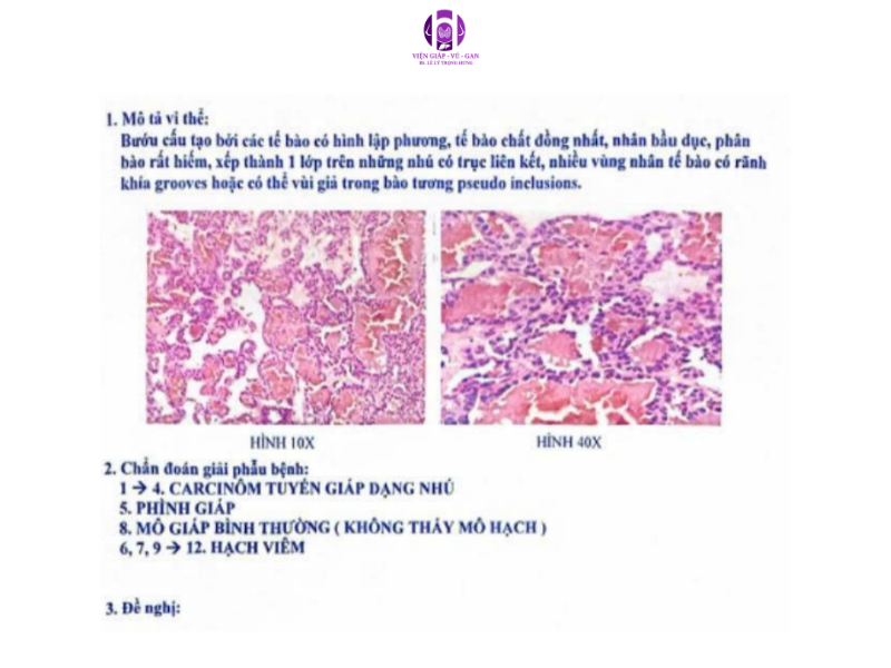Carcinôm tuyến giáp dạng nhú