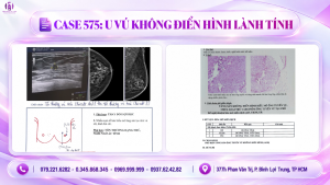 u vú không điển hình lành tính
