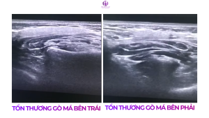 CASE 04: TUYẾN MANG TAI PHỤ (ACCESSORY PAROTID GLANDS)