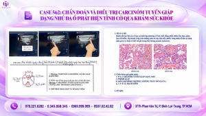 Carcinôm tuyến giáp dạng nhú