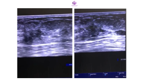 Sclerosing adenosis