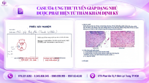 ung thư tuyến dạng nhú