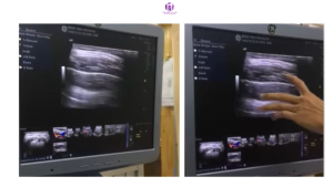 Khối bướu vùng hông lưng